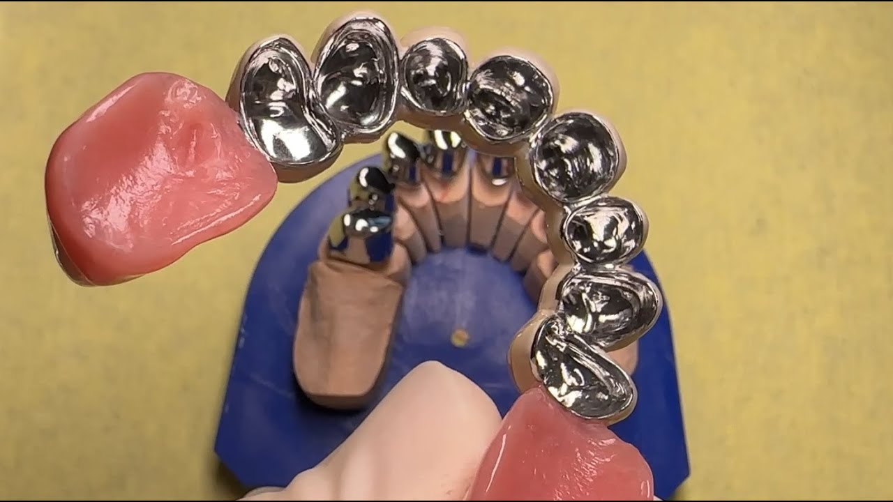 Kunstgebit, frameprothese, plaatje, gebit, gehemelte vrije prothese, telescoopprothese