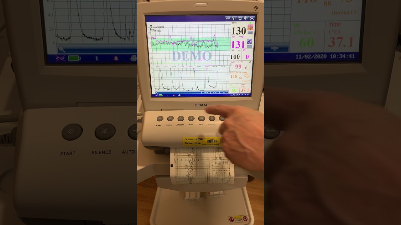 EDAN F9 Express CTG Monitor Training Video