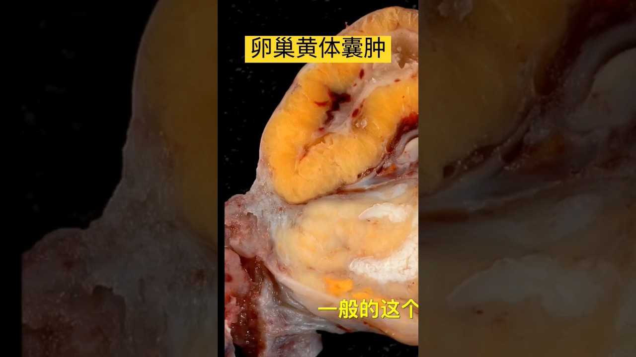 卵巢黄体囊肿是怎么形成的 常见卵巢囊肿 #b超师小默 #超声检查 #健康 ＃卵巢＃阴超＃腹部超声