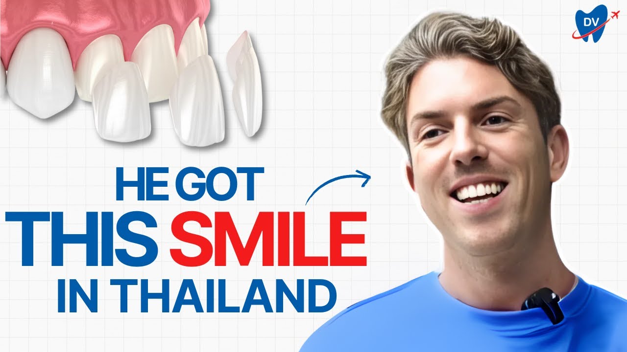 Dental Veneers in Bangkok, Thailand: How a UK Patient Transformed His Smile!