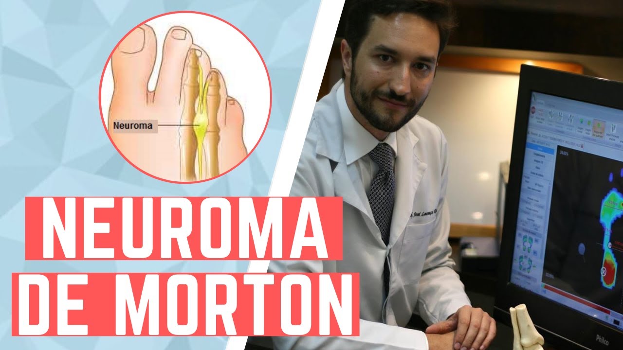 Neuroma de Morton | Dor nos pés | Saiba o que fazer