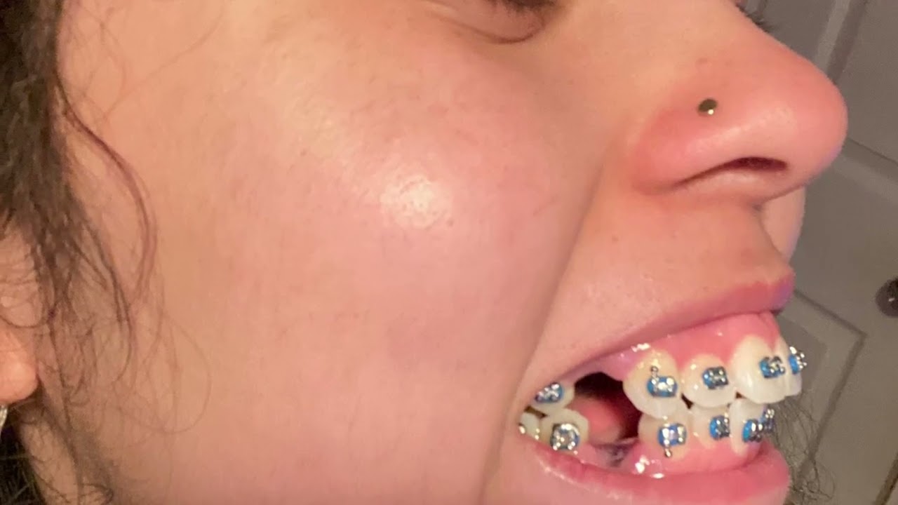 I GOT FOUR PREMOLAR EXTRACTIONS | Braces Update| #braces #extractions #adultbraces #teeth  #vlog