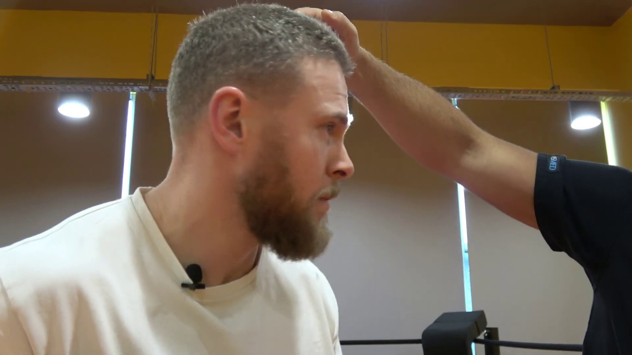 результат пересадки волос 3000 графтов.