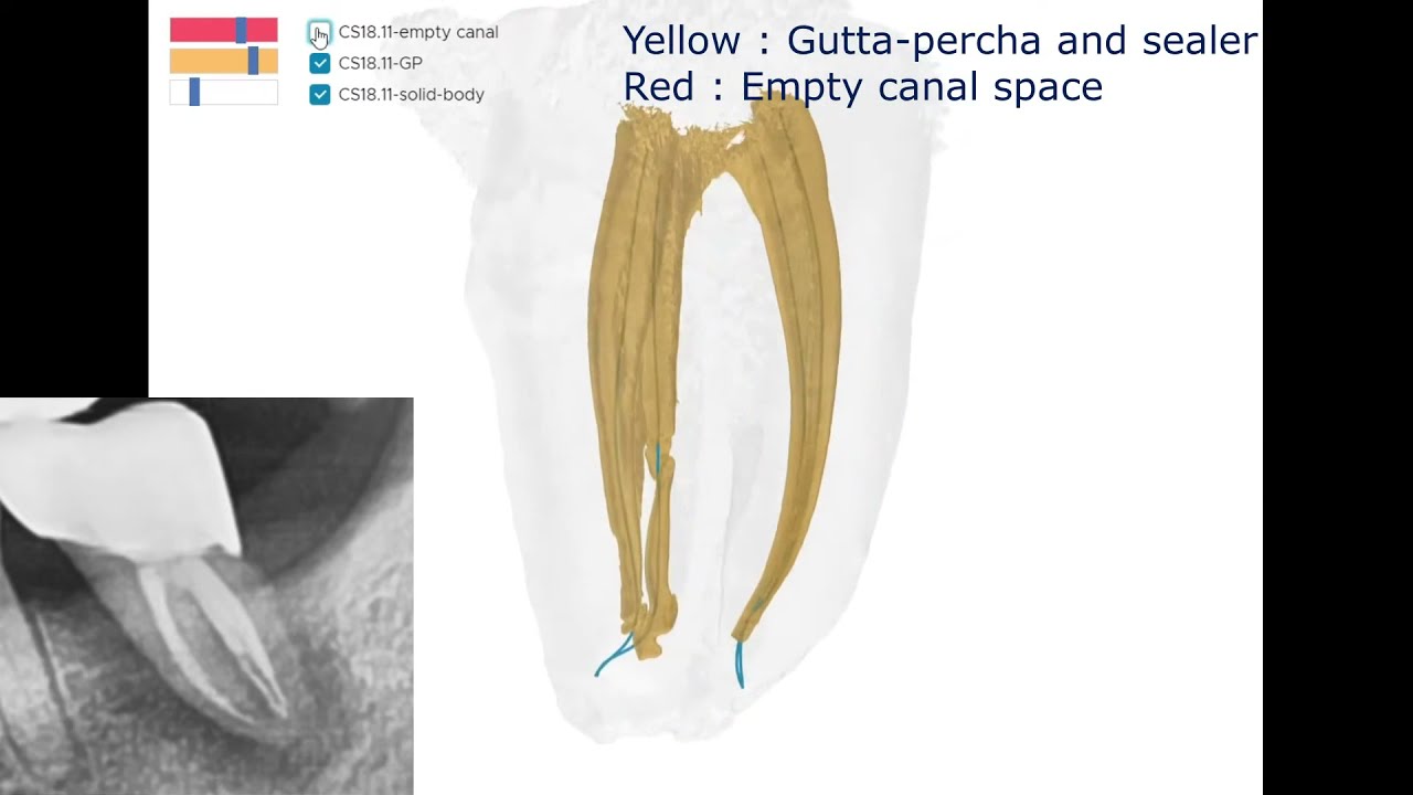 Learn from failure:  C-shape canal
