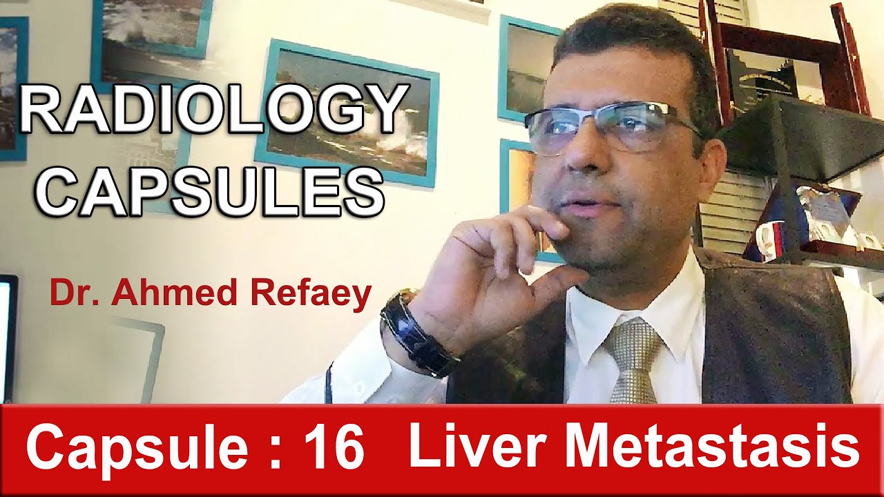 Capsule : 16 - Liver Metastasis