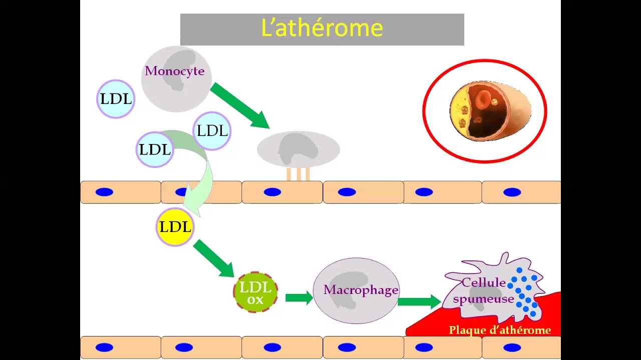 17.Syndromes coronariens aigus ST+ (Pr Nibouche) | #Cardio
