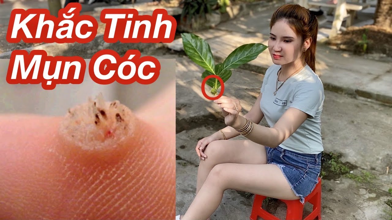 Cách Trị Hết Mụn Cóc Cấp Tóc Siêu Nhanh \100% Trị Hết Mụn Cóc Với Loại Trái Cây Này