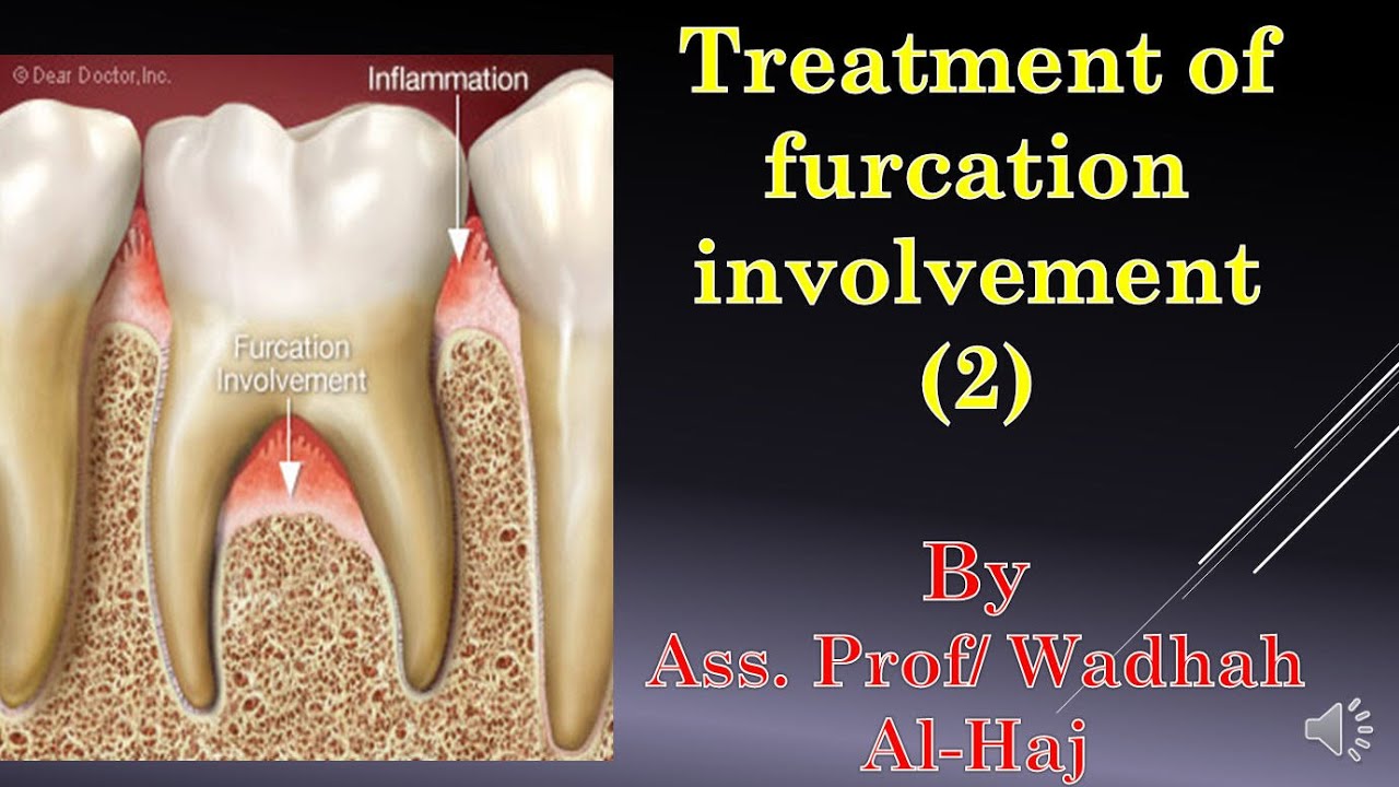 46- Periodontal surgery-14 (Furcation involvement-2)-Dr Wadhah Periodontology lectures.د/ وضاح الحاج