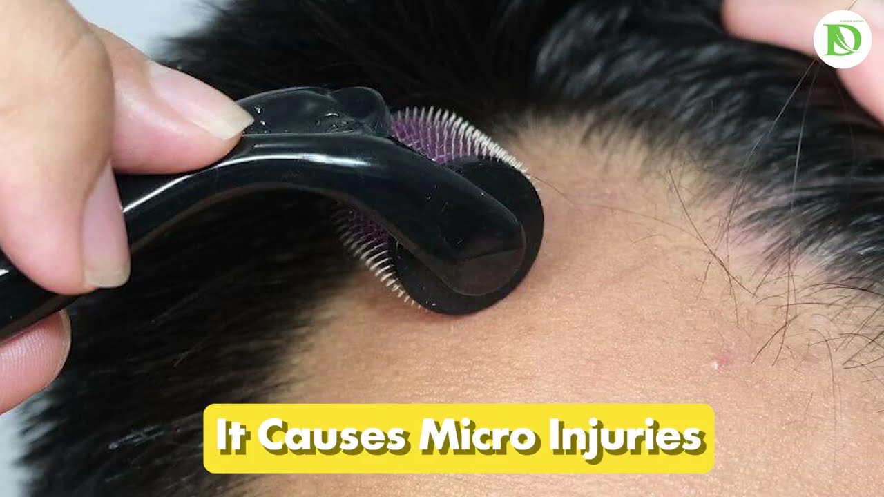 ⚠️ WARNING: Listen to This Before Using a Derma Roller || The Hidden Risks Which No One Tells You