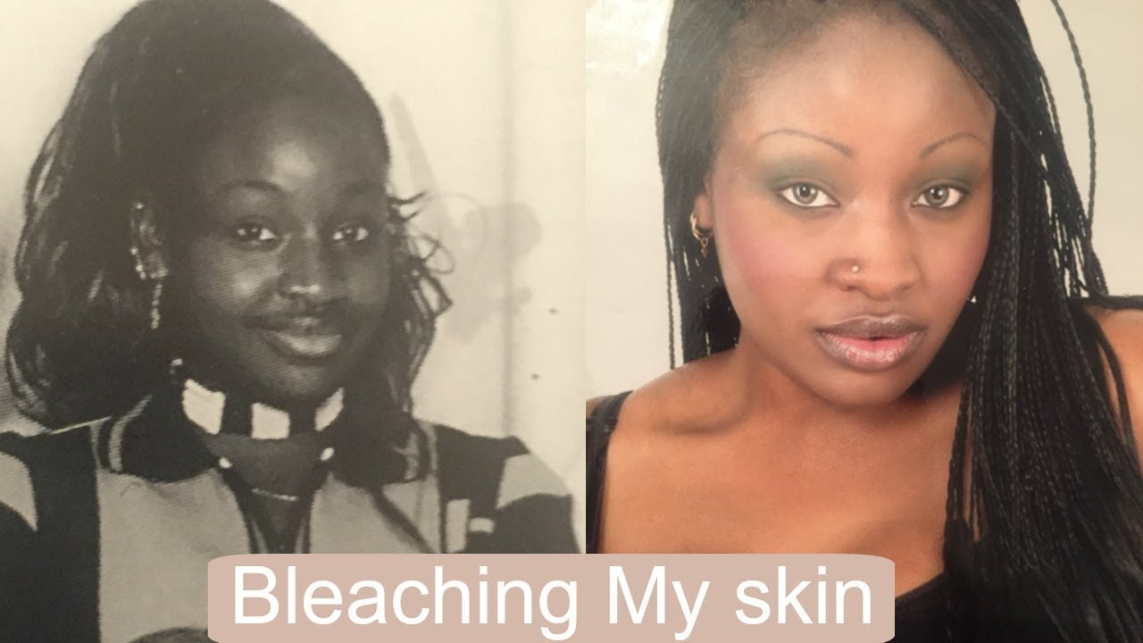 Skin Bleaching in Africa: My Personal Horror Story
