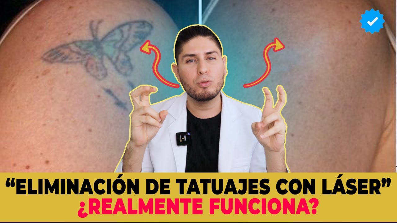 Tecnicas de eliminación de tatuaje ¿El láser es mejor🤔? | DOCTOR LEMUS