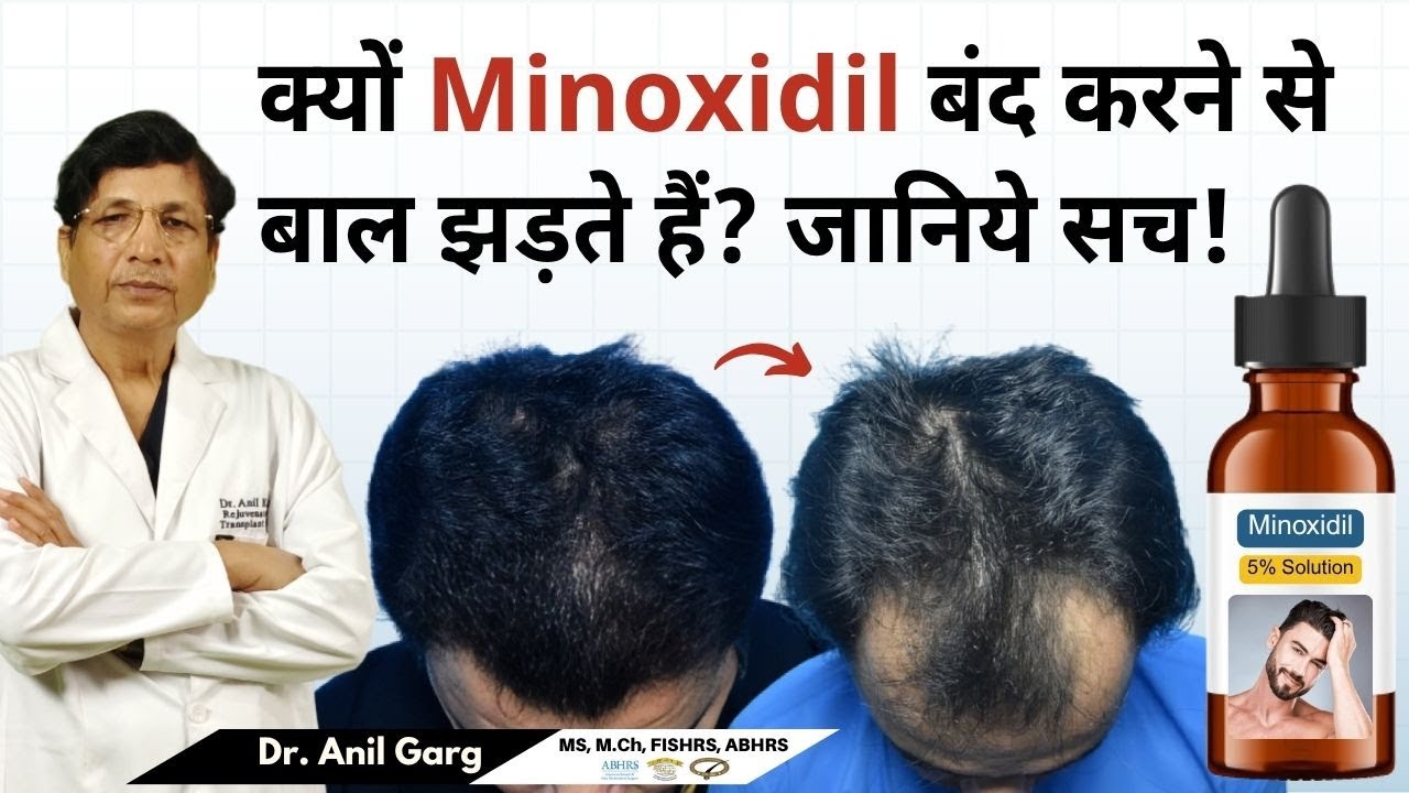 क्यों Minoxidil बंद करने से बाल झड़ते हैं? जानिये सच!