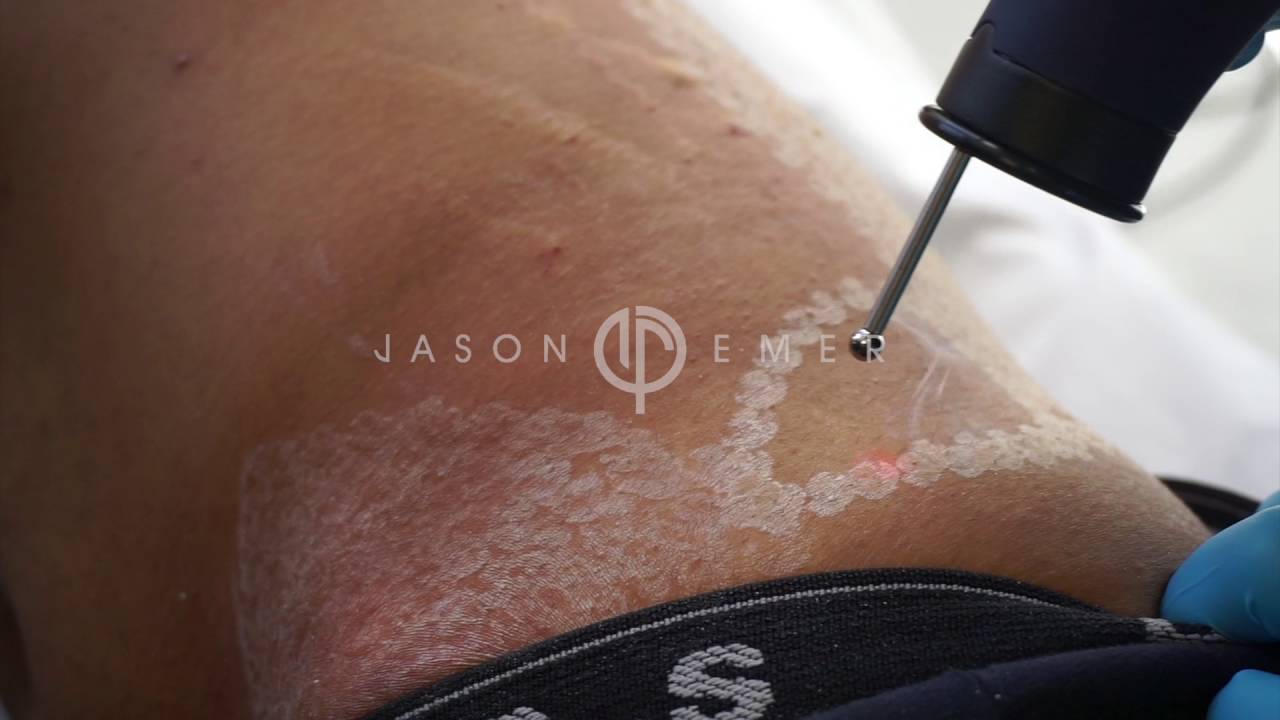 Erbium Laser Stretch Marks / Collagen Production Ablative Laser / Skin Remodeling / Beverly Hills