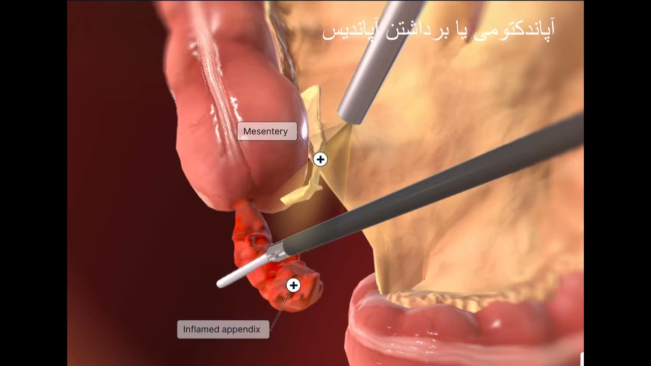 آپاندکتومی ،برداشتن آپاندیس