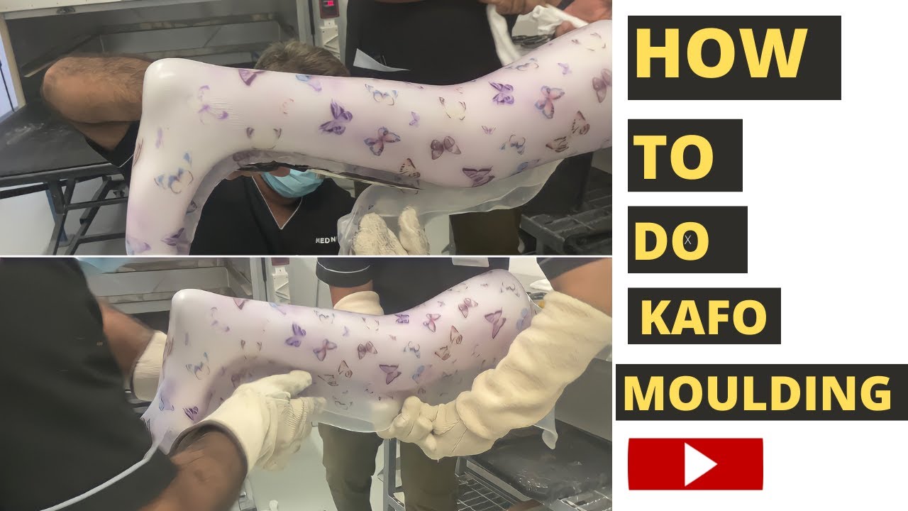 How to do KAFO molding | Molding techniques for orthotic splints and braces.