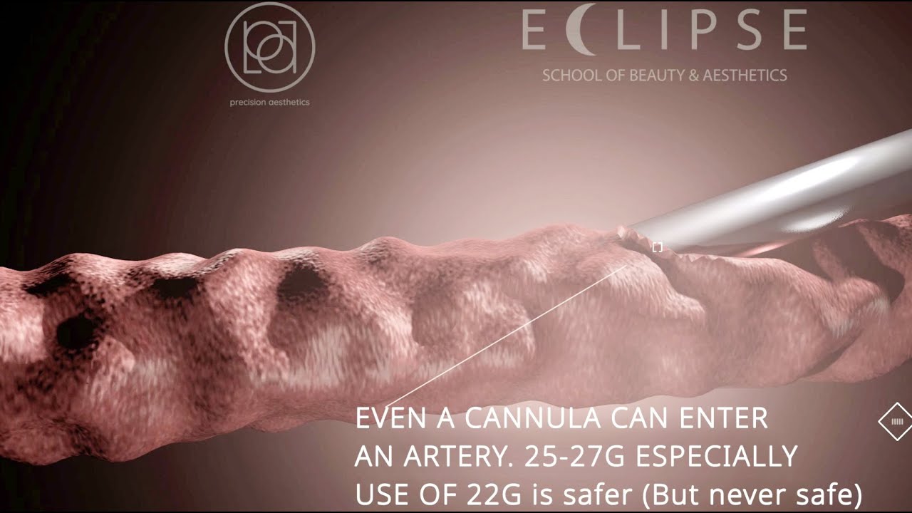 VO Vascular Occlusion From Dermal Fillers