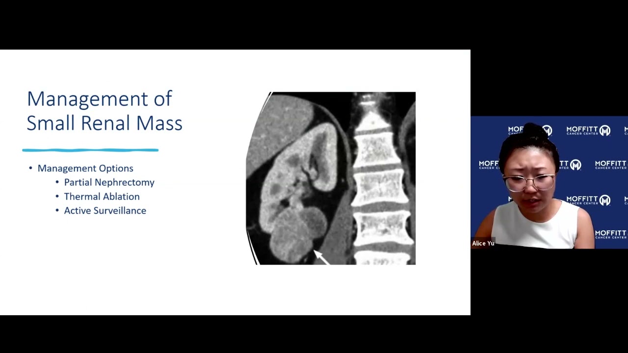 Treatment of Localized Disease in a Solitary Kidney with Dr Alice Yu