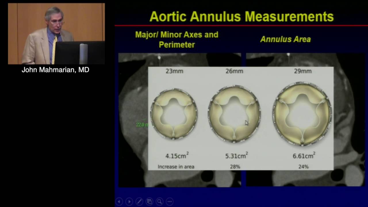 Essential Imaging for TAVR: Annulus, Arch and Access (John Mahmarian, MD) April 30, 2016