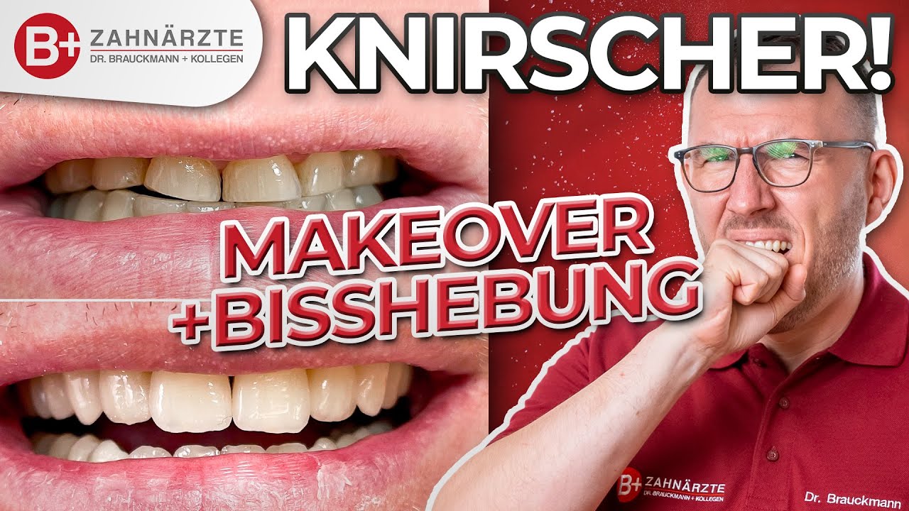 Zähneknirschen - Das kannst Du als Knirscher tun! Patientenfall mit Kronen und Bisshebung gelöst!