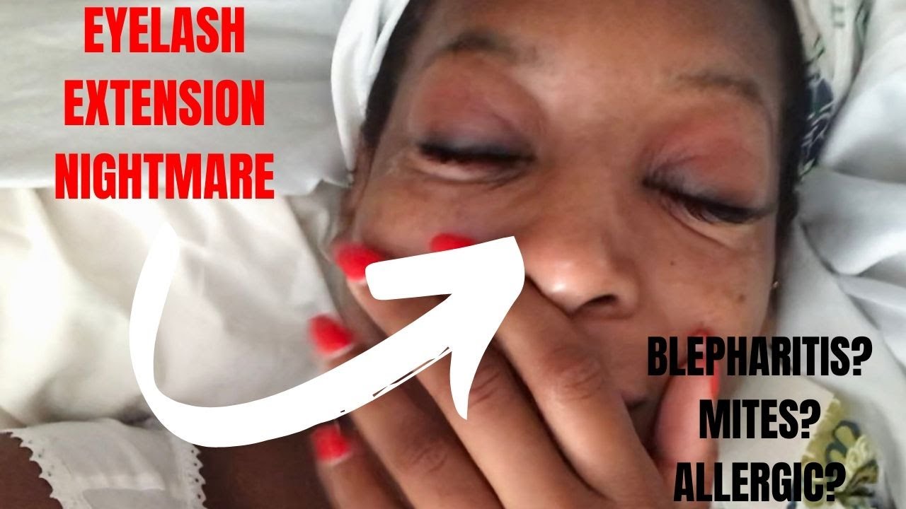 HOW TO TREAT BLEPHARITIS l LASH EXTENSION NIGHTMARE
