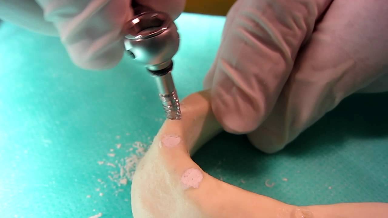 Implantáció menete (implantation) Ecto Derma Polyklinika