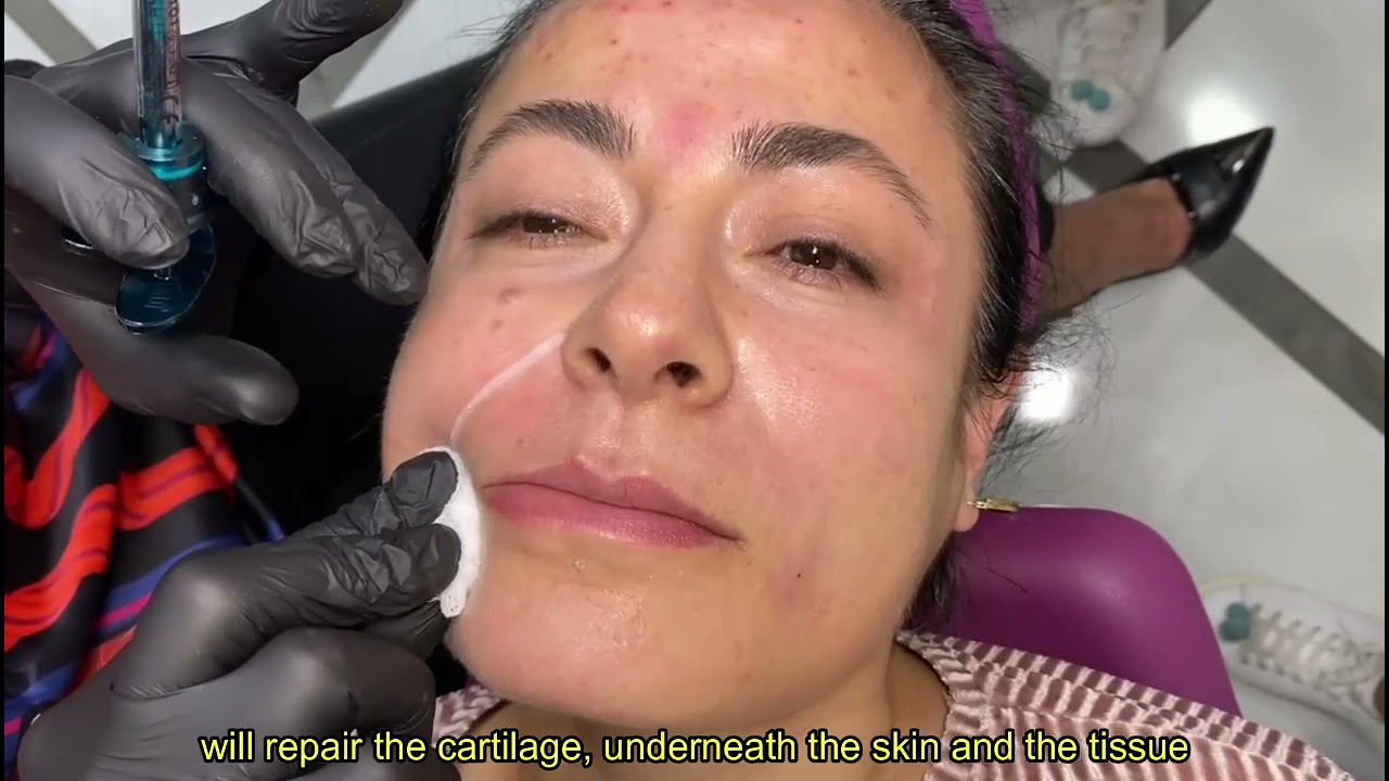 Dr. Nüket Eroğlu, Hydroxiapatite Nasolabial Filler