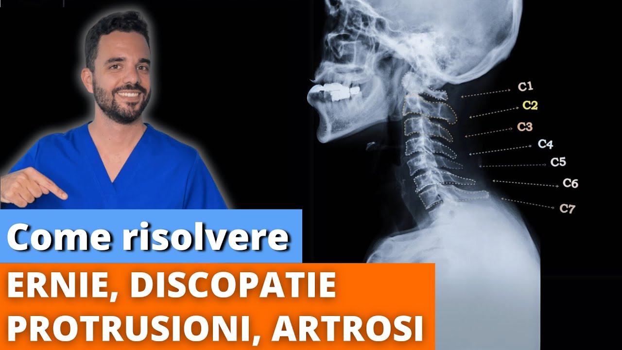 Ernie cervicali, Protrusioni, Artrosi: Scopri le VERE CAUSE e 3 ESERCIZI per ridurre il dolore