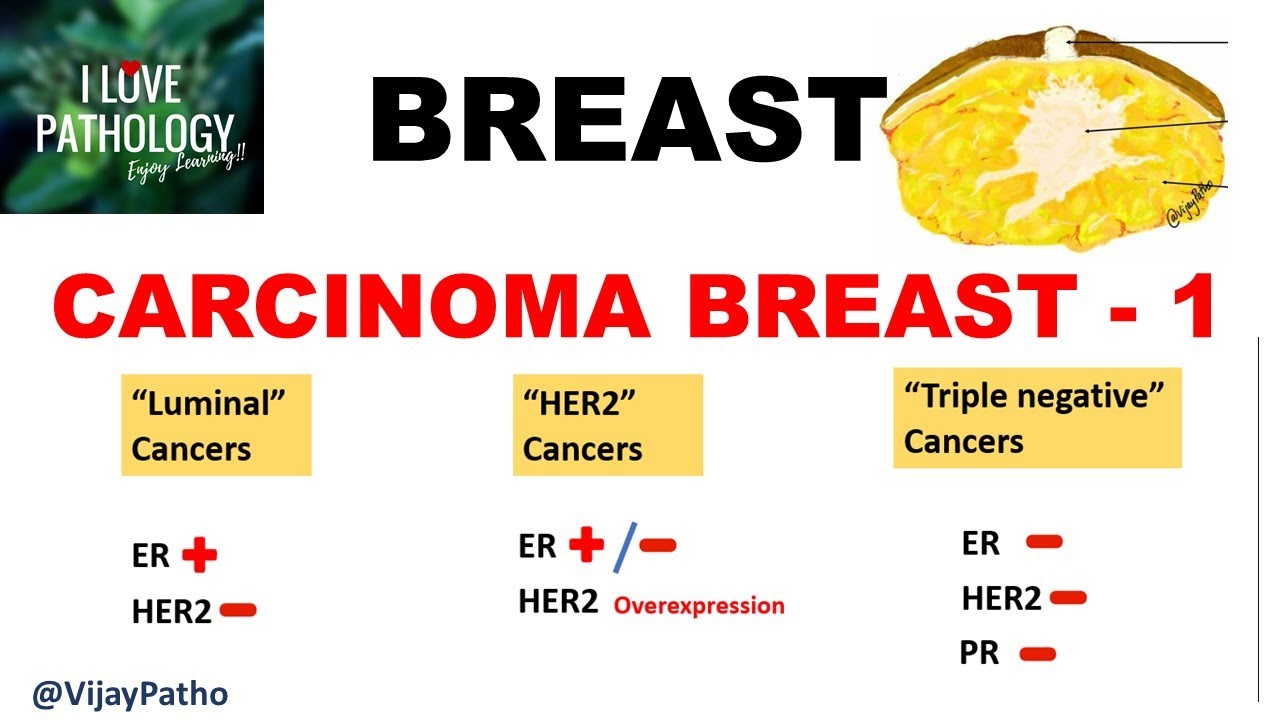 Diseases of Breast: Part 4: Breast carcinoma- risk factors, pathogenesis & classification