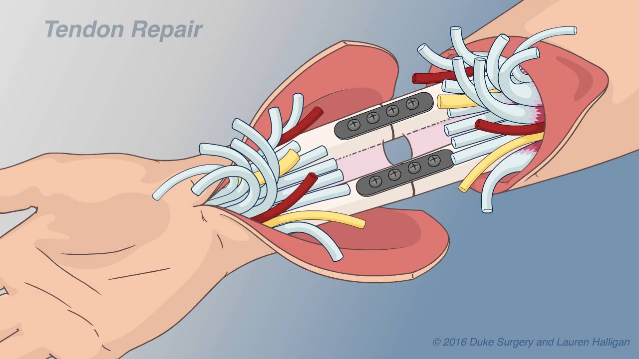 Hand Transplantation