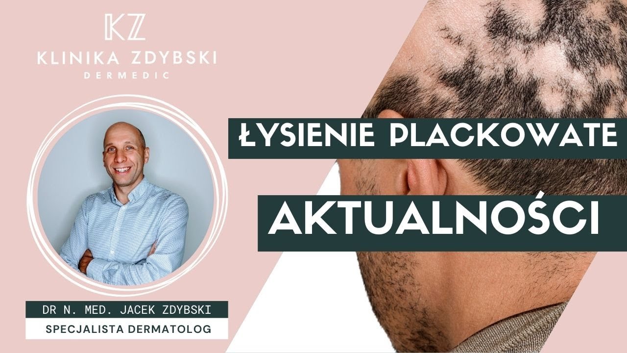 Dermatolog mówi o: Łysienie plackowate - aktualności (maj 2024)