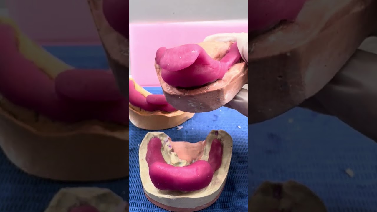 Porta impresiones inferiores de resina acrílica en modelos de pacientes reales