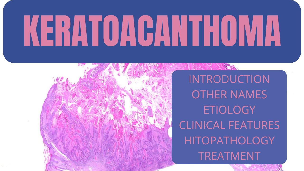 KERATOACANTHOMA I BENIGN & MALIGNANT TUMORS OF ORAL CAVITY I ORAL PATHOLOGY