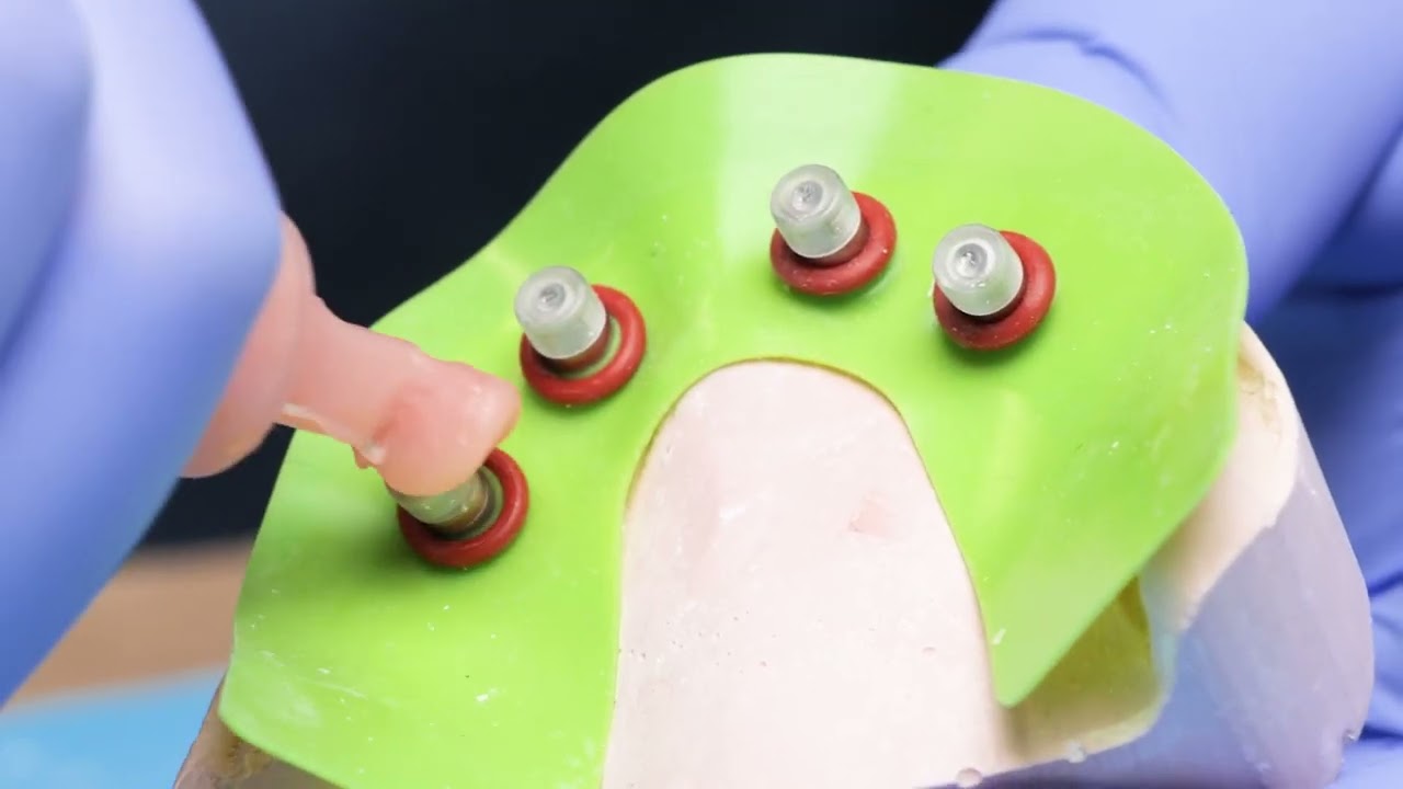 Delivering a Provisional Implant Restoration with Smart Denture Conversions 2.0 from Smart On X