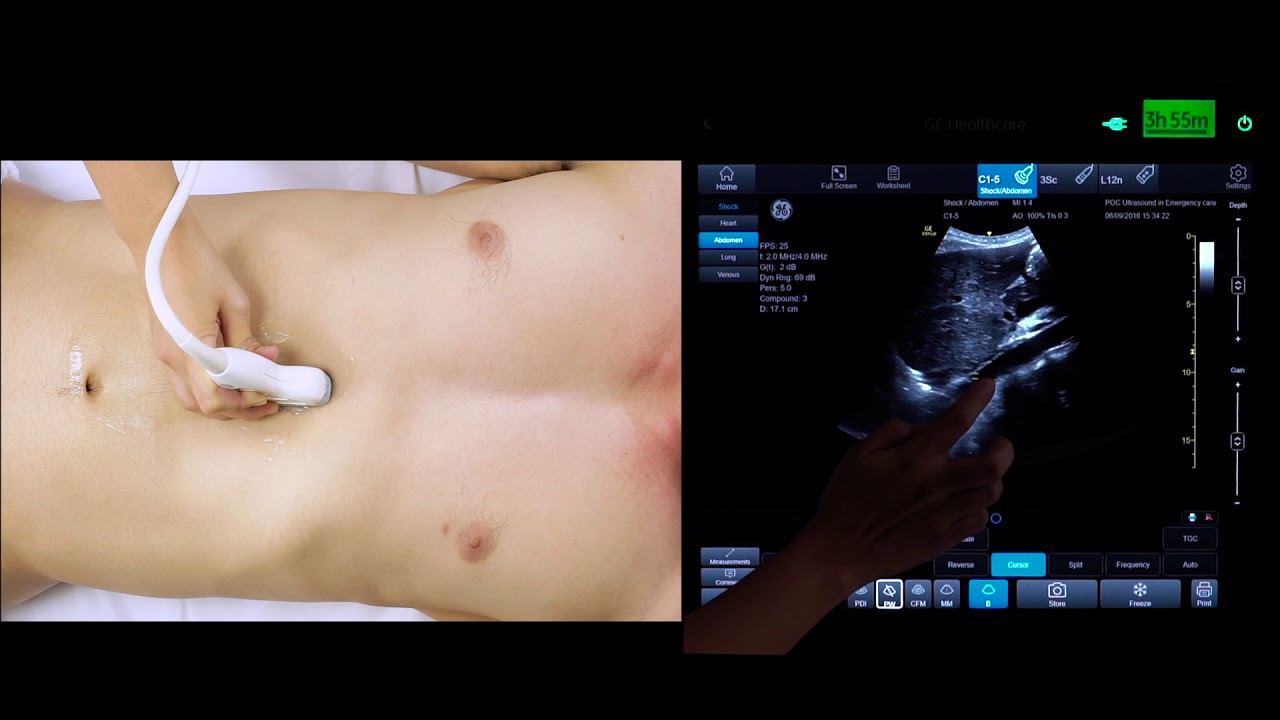 IVC vs Aorta bedside scanning