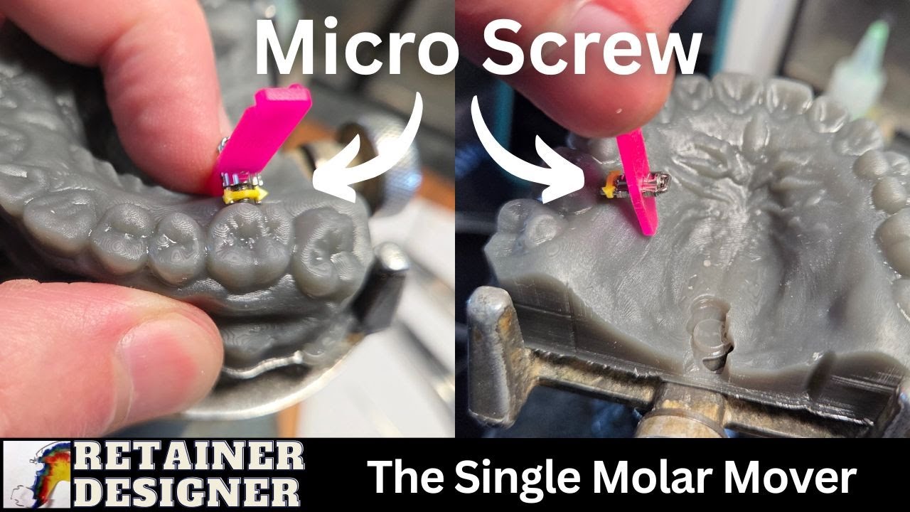 Adding a Micro-Screw to a Hawley Retainer to move a Molar