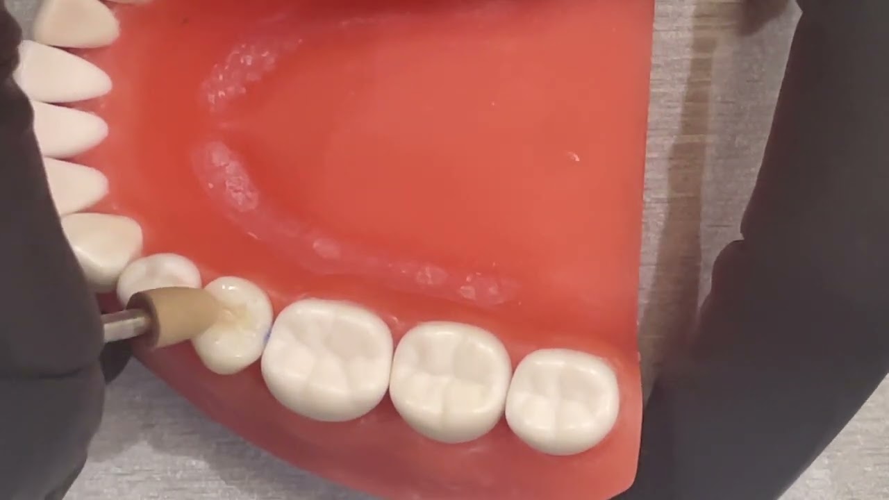 Polishing & Shaping a Premolar Composite for ADEX | Step-by-Step Tips!