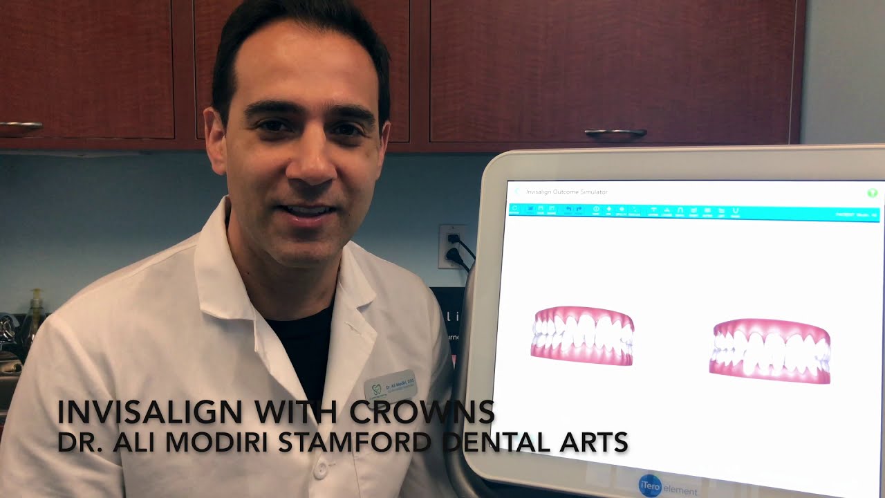 Invisalign with Crowns