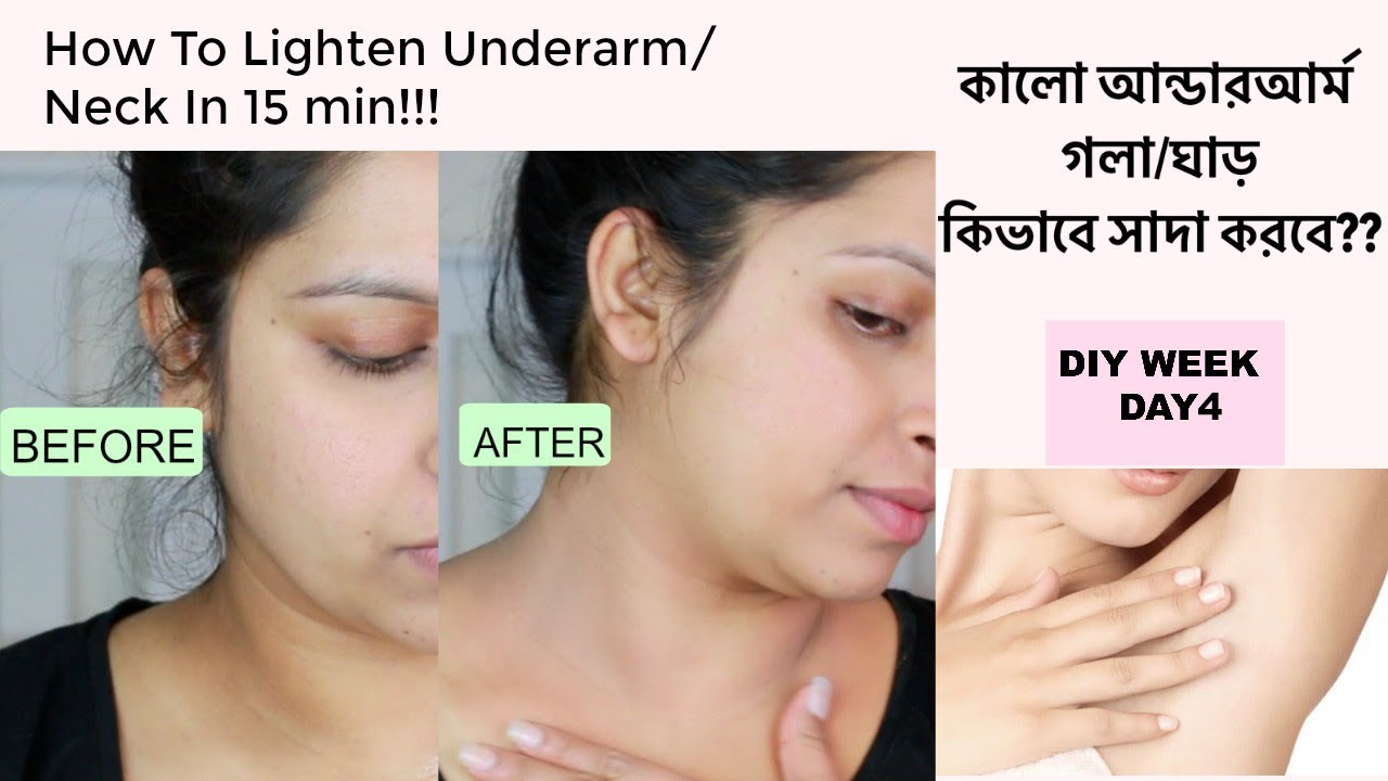 How To Lighten Dark Underarm/Neck Instant Result in 15 min | natural way | Shahnaz Shimul