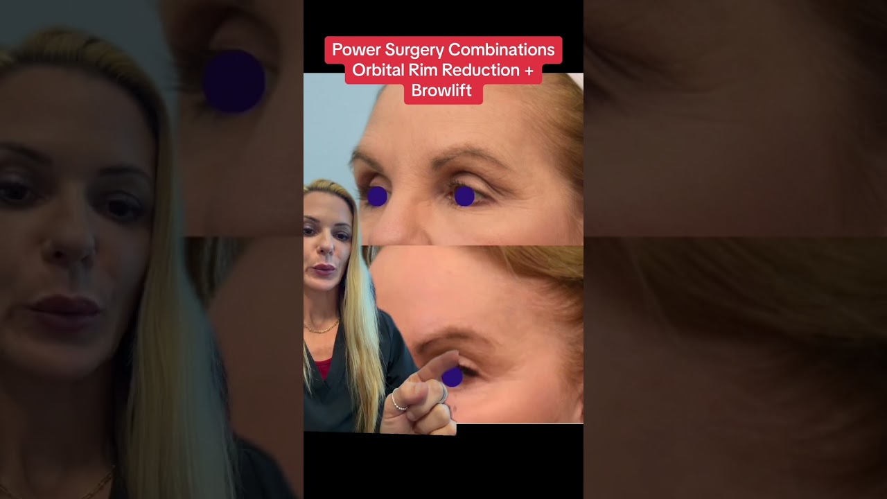 Orbital Rim + Browlift