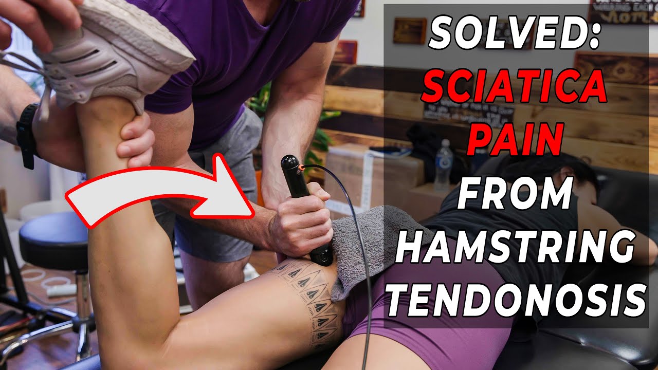 Sciatica & Butt Pain? How Hamstring Tendonosis Causes It — And How Shockwave Helps