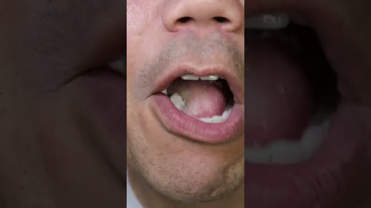 mentos Chewy Dragee buah #DoctorTristanPeh #ASMR #Shorts