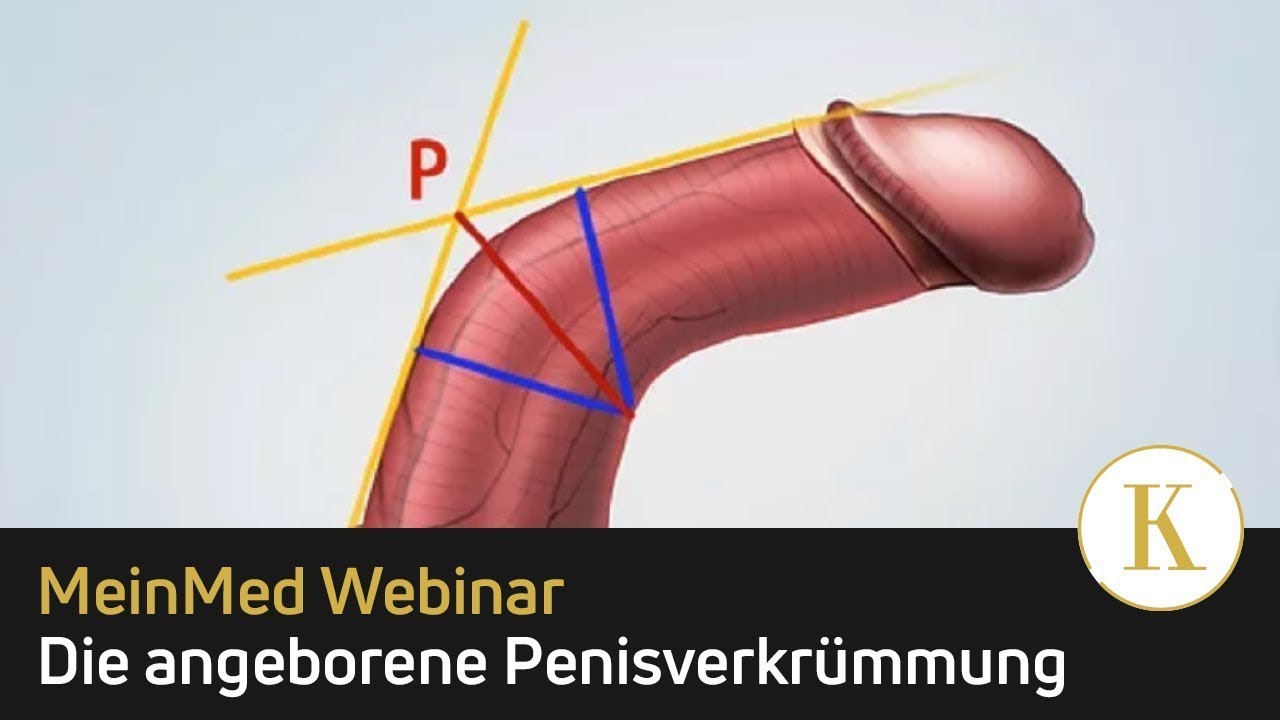 Angeborene Penisverkrümmung  | MeinMed Webinar