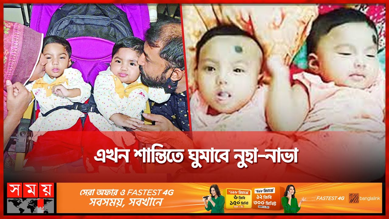 অস্ত্রোপচারে আলাদা হলো মেরুদণ্ডে জোড়া লাগা নুহা-নাভা | Nuha Naba | Twin Sisters with Spinal Fusion