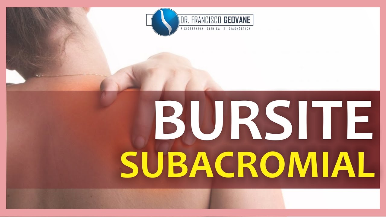 BURSITE SUBACROMIAL: O que &eacute;, como se instala e qual seu mecanismo de les&atilde;o.