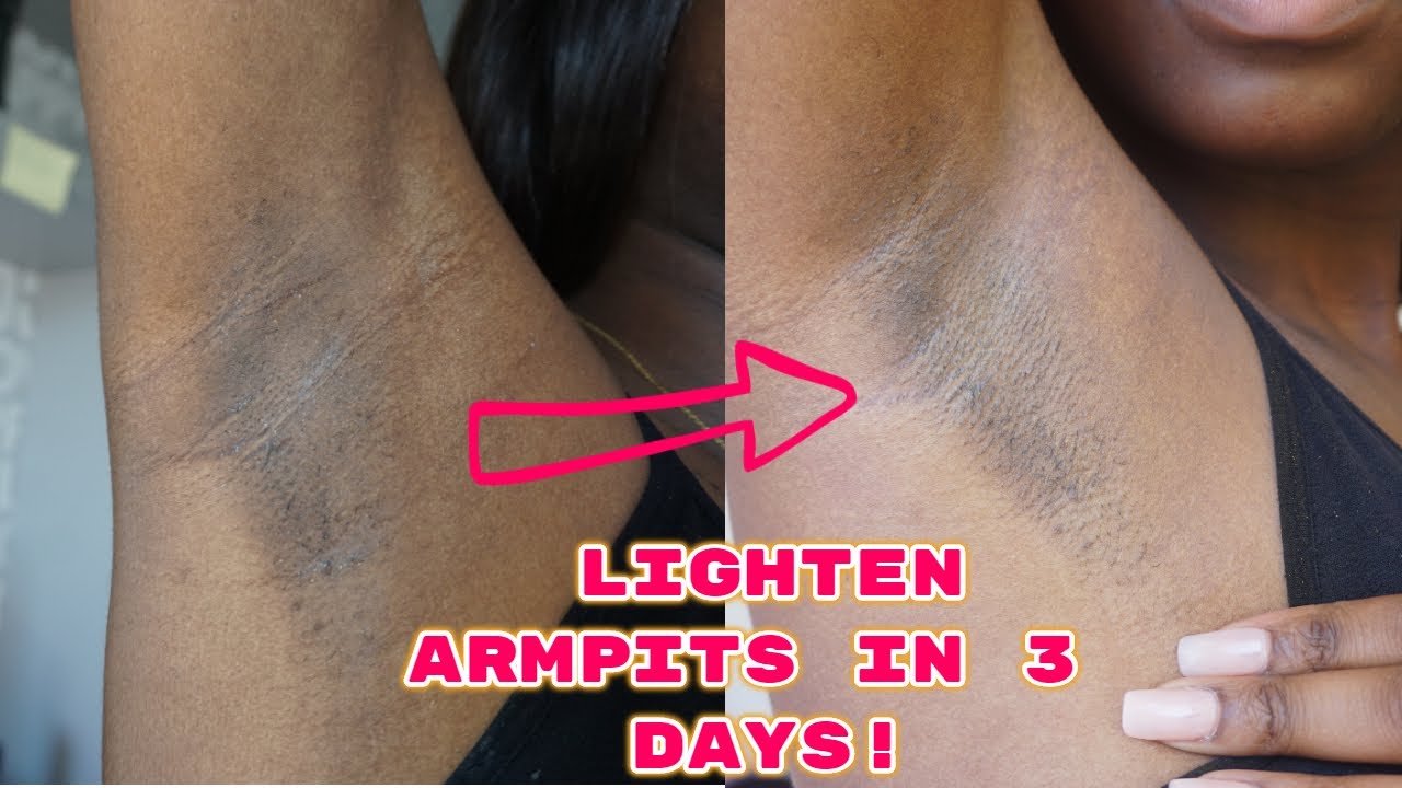 LIGHTEN ARMPITS IN 3 DAYS | Real results!