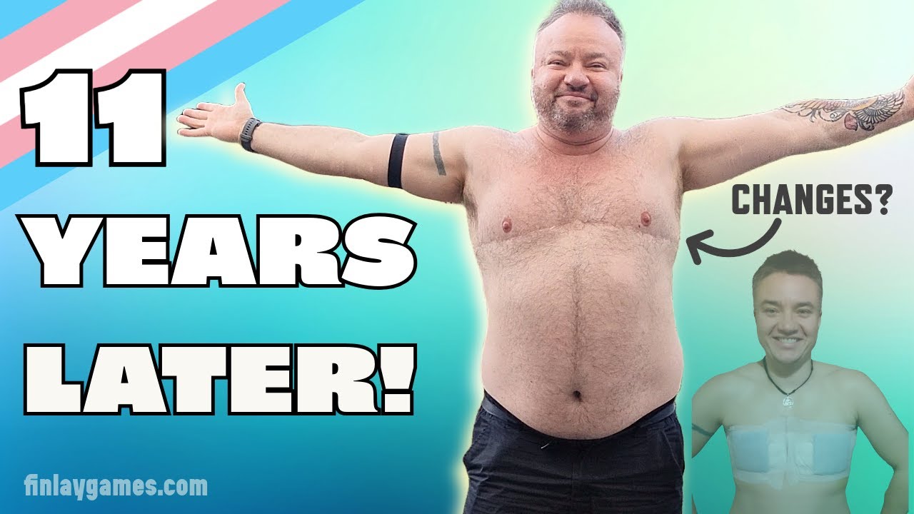 11 Years Post-Top Surgery: Scars, Changes & Self-Love