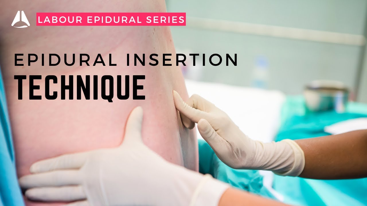 The Epidural Insertion | 