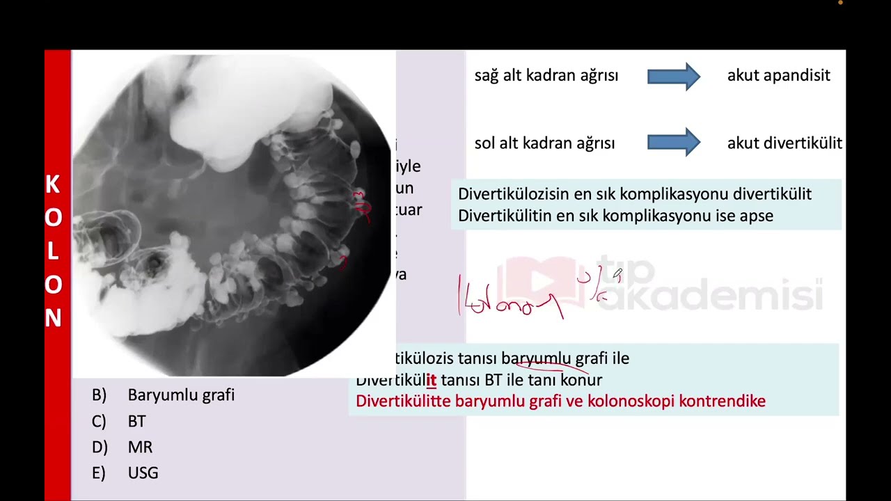 Divertikülit Sorusu Referansımız “Soru Kampı”