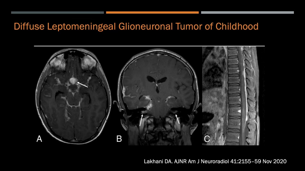 Acute encephalopathy