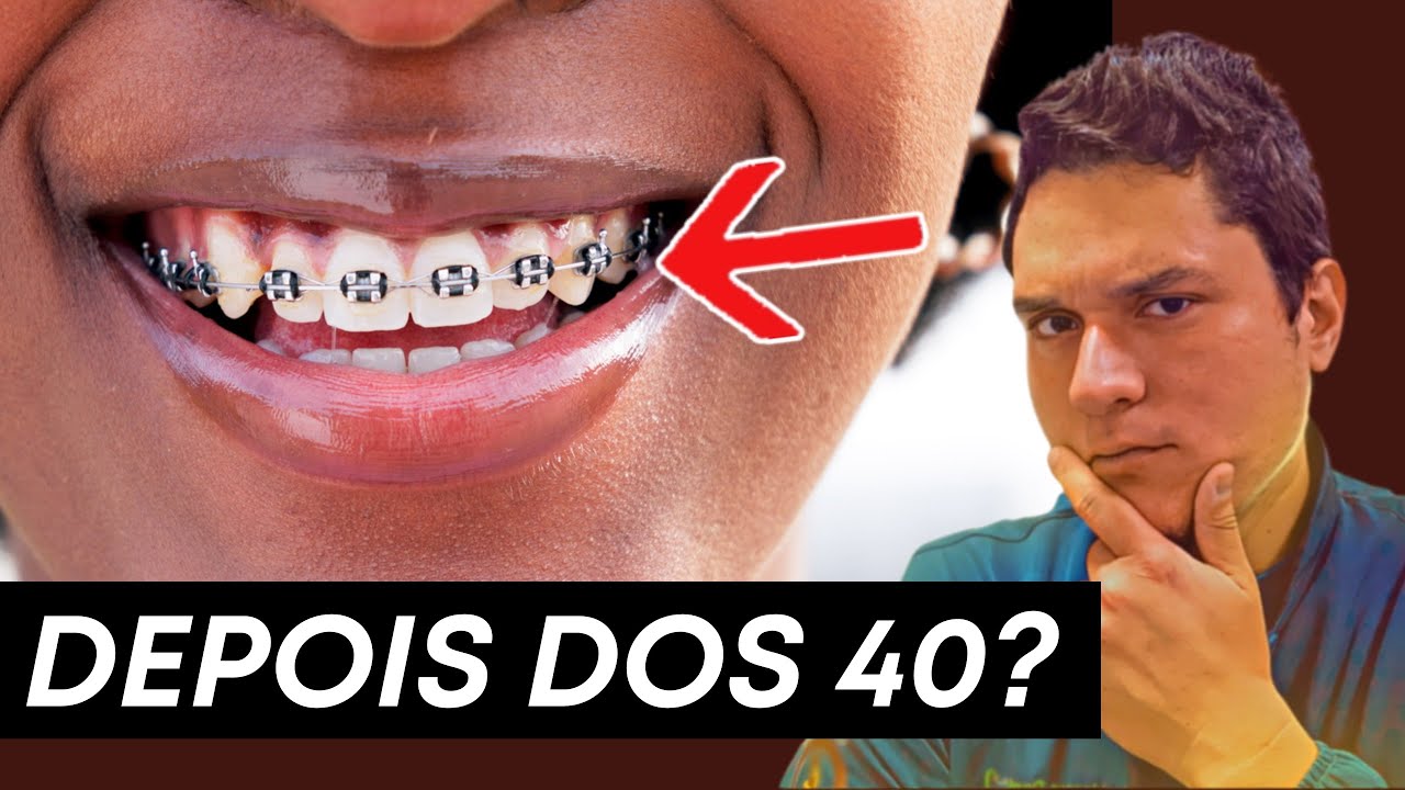 Aparelho Ortodôntico DEPOIS dos 40 é possível? A VERDADE que POUCOS falam…